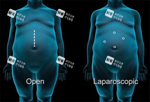 袖状胃切除手术卡通图 袖状胃切除手术卡通图