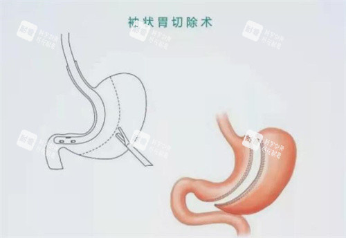 袖状胃切除手术卡通示意图 袖状胃切除手术卡通示意图