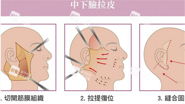 面部拉皮手术 面部拉皮手术