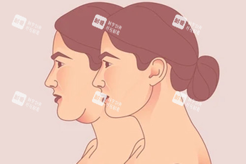 颈部拉皮变成天鹅颈 颈部拉皮变成天鹅颈