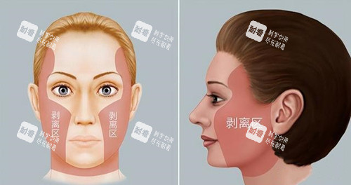 拉皮手术剥离区 拉皮手术剥离区