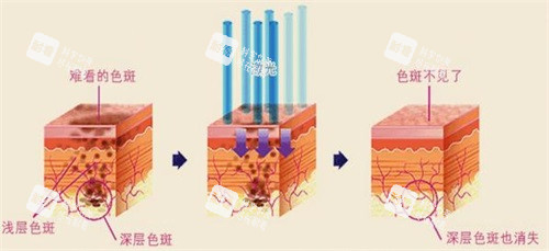 激光祛斑 (5) 激光祛斑 (5)