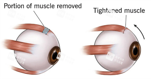斜视眼睛肌肉和正常眼睛肌肉不同 斜视眼睛肌肉和正常眼睛肌肉不同