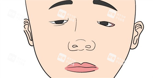 小睑裂综合征卡通图