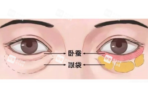 眼袋、卧蚕区分图 眼袋、卧蚕区分图