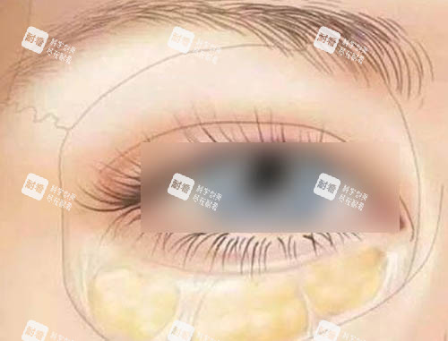 眼袋模拟图 眼袋模拟图