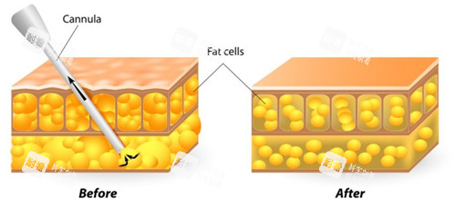 吸脂前后对比图示 吸脂前后对比图示
