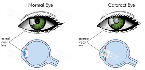 正常眼睛和白内障眼睛晶体区别 正常眼睛和白内障眼睛晶体区别