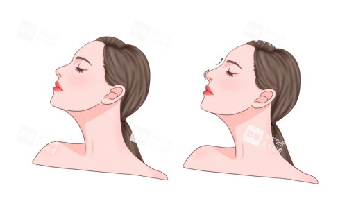 鼻整形术后示意图 鼻整形术后示意图