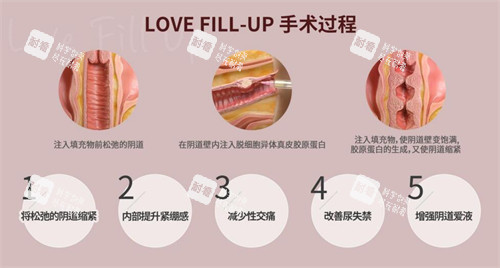 韩国信所爱女性医院阴道注射 韩国信所爱女性医院阴道注射