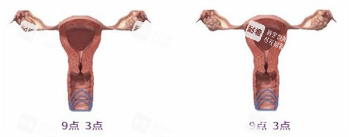 阴道紧缩手术 阴道紧缩手术