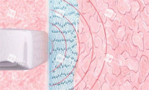 阴道紧缩原理 阴道紧缩原理