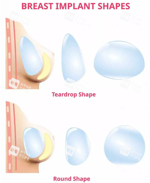 不同假体植入体内的形态 不同假体植入体内的形态