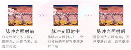 光子嫩肤对比