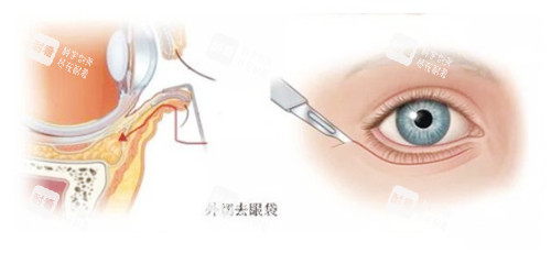 去眼袋切口图示 去眼袋切口图示