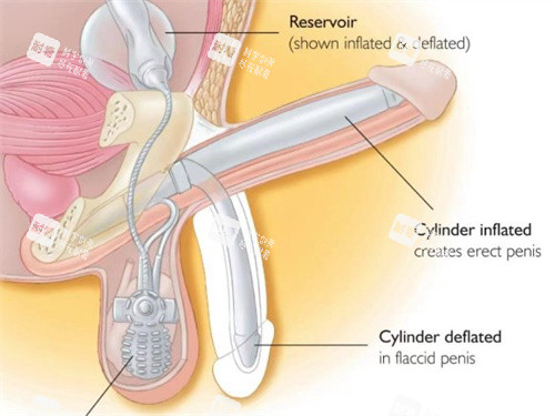 可膨胀性人工海绵体植入术后 可膨胀性人工海绵体植入术后