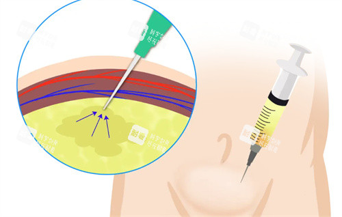 丁丁打玻尿酸动画图 丁丁打玻尿酸动画图