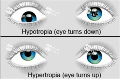 上下斜视 上下斜视