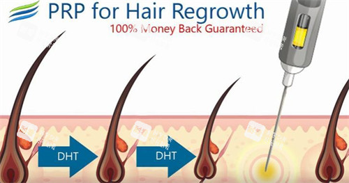 脱发PRP注射治疗原理介绍 脱发PRP注射治疗原理介绍
