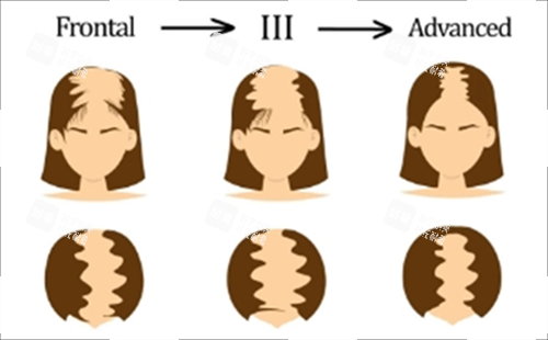 重度脱发素材 重度脱发素材