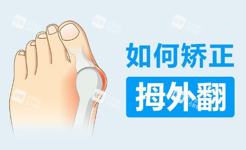 如何矫正拇外翻 如何矫正拇外翻