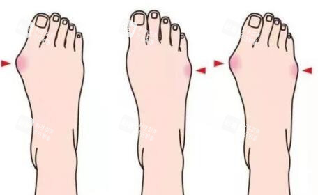 拇外翻卡通图照片 拇外翻卡通图照片