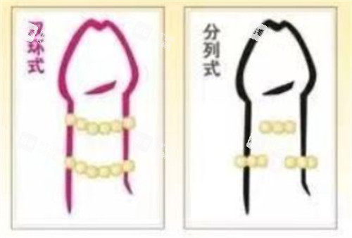 阴茎入珠术款式有哪些