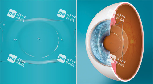 人工晶体植入眼睛演示图展示