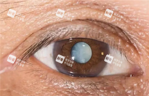 白内障眼球图 白内障眼球图