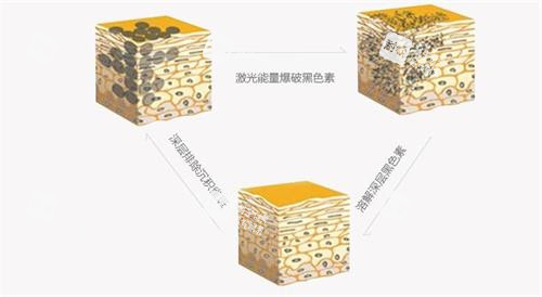 激光祛雀斑的原理