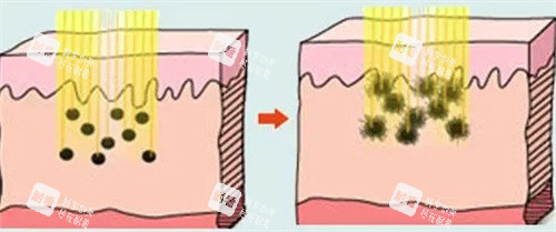 激光去黑色素 激光去黑色素