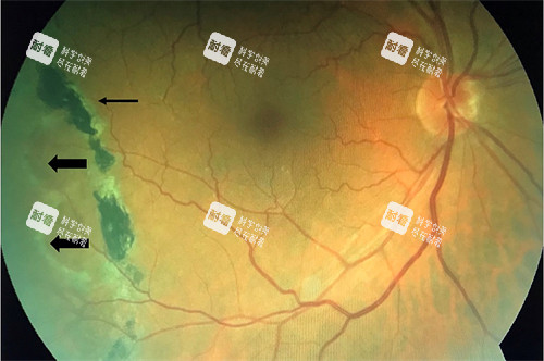 视网膜劈裂演示图