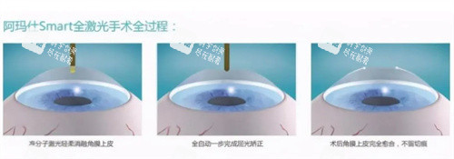 阿玛仕全激光手术全过程 阿玛仕全激光手术全过程