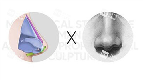 隆鼻改善展示照片