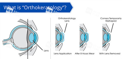 OK镜改善角膜弧度 OK镜改善角膜弧度
