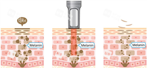 激光改善面部斑点 激光改善面部斑点