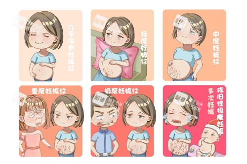 各类妊娠纹图片展示 各类妊娠纹图片展示