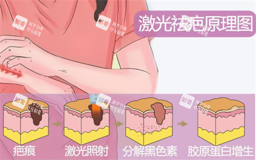 激光祛疤原理示图 激光祛疤原理示图