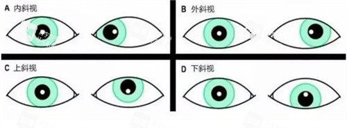 斜视的种类卡通