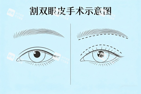 割双眼皮手术示意图