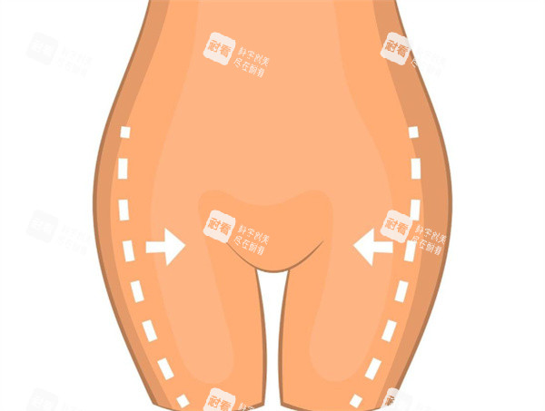 大腿吸脂手术卡通图