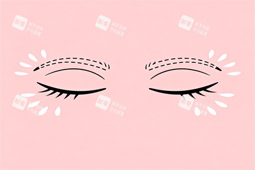 双眼皮整形卡通图