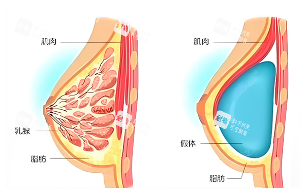 隆胸假体放置位置 隆胸假体放置位置