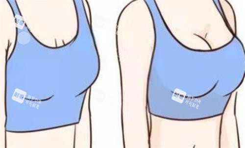 隆胸前后对比图