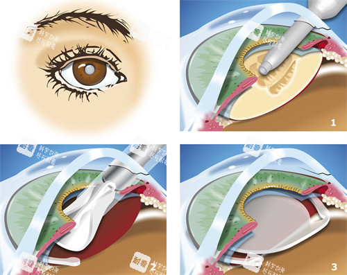 西安西京医院白内障手术费用价格表：超声乳化6000元起、白内障晶体5000元起