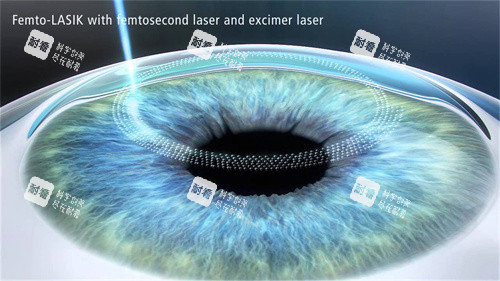 2026年飞秒手术价格一览表：近视手术大概多少费用2026年价目表分享！