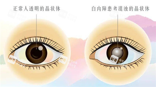 白内障和正常眼球的对比图 白内障和正常眼球的对比图