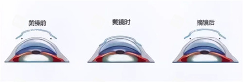 角膜塑形镜佩戴