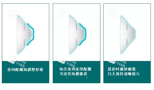 角膜塑形镜的原理