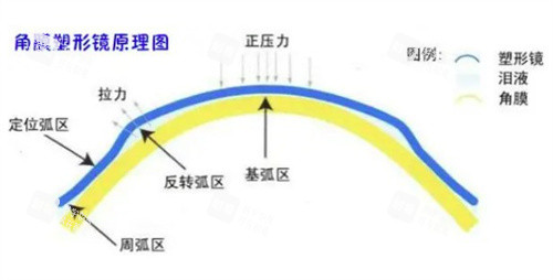 角膜塑形镜原理示意图 角膜塑形镜原理示意图